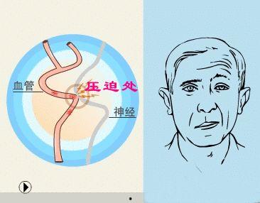 痉挛图片,捕捉肌肉紧张之美